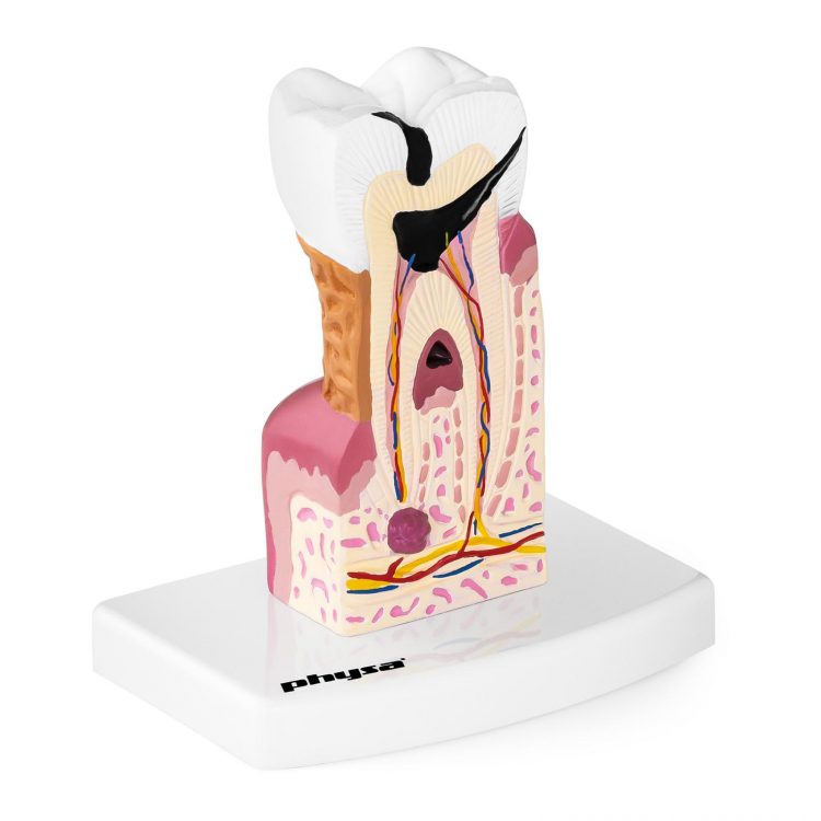model chorého zuba